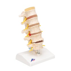 3B Scientific Stages of Disc Prolapse and Vertebral Degeneration Vertebra