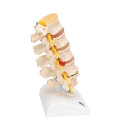 3B Scientific Stages of Disc Prolapse and Vertebral Degeneration Vertebra