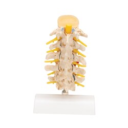 3B Scientific Stages of Disc Prolapse and Vertebral Degeneration Vertebra