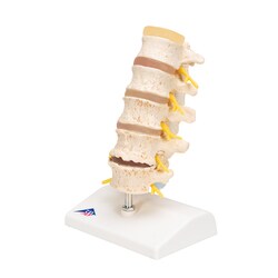 3B Scientific Stages of Disc Prolapse and Vertebral Degeneration Vertebra