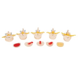 3B Scientific Stages of Disc Prolapse and Vertebral Degeneration Vertebra