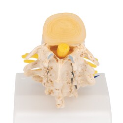 3B Scientific Stages of Disc Prolapse and Vertebral Degeneration Vertebra