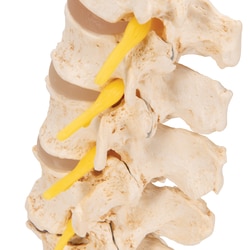 3B Scientific Stages of Disc Prolapse and Vertebral Degeneration Vertebra