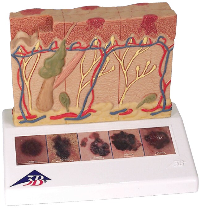 3B Scientific Skin Cancer Model Skin Cancer Model, Enlarged 8XTeaching