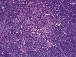 Eisco™ Human Melanoma