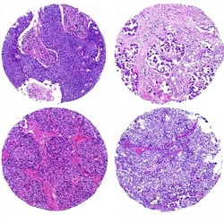 Mopec™ Control Slides, Tissue Microarray, 16 Breast Tumors