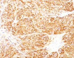 Melanoma Marker (MART-1 + gp100) Antibody (DT101+ BC199 + HMB45), Novus