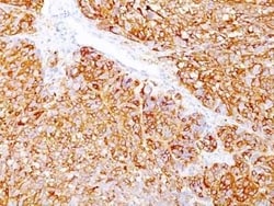 Melanoma Marker (MART-1 + gp100) Antibody (DT101+ BC199 + HMB45), Novus