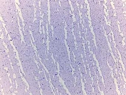 Novus Biologicals&trade;&nbsp;Brain Amygdala Tissue Slides (Alzheimer's)- Paraffin