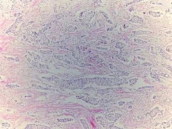 Novus Biologicals Breast Tissue Slides (Lobular Carcinoma)- Paraffin 5 Slides | Buy Online | Novus Biologicals&trade; | Fisher Scientific