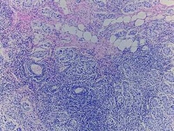 Novus Biologicals&trade;&nbsp;Breast Tissue Slides (Medullarycarcinoma)- Paraffin