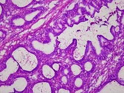 Novus Biologicals Colon Matched Tumor and Normal Tissue Slides (Tumor)- Frozen 10 Slides | Buy Online | Novus Biologicals&trade; | Fisher Scientific