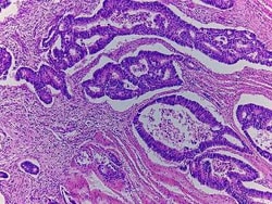 Novus Biologicals Colon Tissue Slides (Adenocarcinoma)- Paraffin 5 Slides:Reactivos