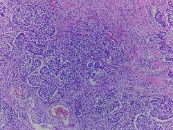 Novus Biologicals Colon Tissue Slides (Adenocarcinoma (Ulcer))- Paraffin 5 Slides | Buy Online | Novus Biologicals&trade; | Fisher Scientific