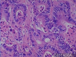 Novus Biologicals&trade;&nbsp;Colon adenocarcinoma tissue Tissue Slides (Adenocarcinoma)- Paraffin