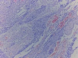 Novus Biologicals&trade;&nbsp;Esophagus Tissue Slides (Squamous Cell Carcinoma)- Paraffin