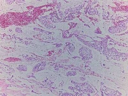 Novus Biologicals Gallbladder Tissue Slides (Adenocarcinoma)- Paraffin 5 Slides | Buy Online | Novus Biologicals&trade; | Fisher Scientific