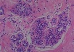Thumbnail_Novus Biologicals Human Multi-tissue Tissue MicroArray (Cancer) Human Ovary