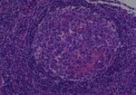 Thumbnail_Novus Biologicals Human Multi-tissue Tissue MicroArray (Cancer) Human Ovary