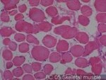 Thumbnail_Novus Biologicals Human Multi-tissue Tissue MicroArray (Cancer) Human Ovary