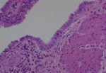 Thumbnail_Novus Biologicals Human Multi-tissue Tissue MicroArray (Cancer) Human Ovary
