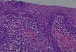 Thumbnail_Novus Biologicals Human Multi-tissue Tissue MicroArray (Cancer) Human Ovary