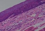 Thumbnail_Novus Biologicals Human Multi-tissue Tissue MicroArray (Cancer) Human Ovary