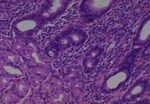 Thumbnail_Novus Biologicals Human Multi-tissue Tissue MicroArray (Cancer) Human Ovary