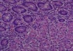 Thumbnail_Novus Biologicals Human Multi-tissue Tissue MicroArray (Cancer) Human Ovary