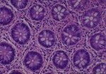 Thumbnail_Novus Biologicals Human Multi-tissue Tissue MicroArray (Cancer) Human Ovary