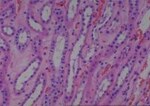 Thumbnail_Novus Biologicals Human Multi-tissue Tissue MicroArray (Cancer) Human Ovary