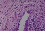Thumbnail_Novus Biologicals Human Multi-tissue Tissue MicroArray (Cancer) Human Ovary
