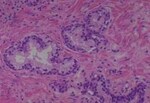 Thumbnail_Novus Biologicals Human Multi-tissue Tissue MicroArray (Cancer) Human Ovary