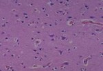 Thumbnail_Novus Biologicals Human Multi-tissue Tissue MicroArray (Cancer) Human Ovary