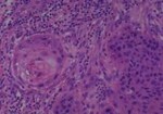 Thumbnail_Novus Biologicals Human Multi-tissue Tissue MicroArray (Cancer) Human Ovary