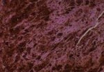 Thumbnail_Novus Biologicals Human Multi-tissue Tissue MicroArray (Cancer) Human Ovary