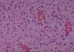 Thumbnail_Novus Biologicals Human Multi-tissue Tissue MicroArray (Cancer) Human Ovary