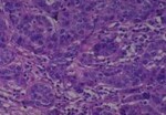 Thumbnail_Novus Biologicals Human Multi-tissue Tissue MicroArray (Cancer) Human Ovary