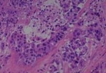 Thumbnail_Novus Biologicals Human Multi-tissue Tissue MicroArray (Cancer) Human Ovary