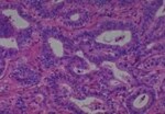Thumbnail_Novus Biologicals Human Multi-tissue Tissue MicroArray (Cancer) Human Ovary