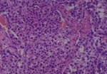 Thumbnail_Novus Biologicals Human Multi-tissue Tissue MicroArray (Cancer) Human Ovary
