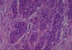Thumbnail_Novus Biologicals Human Multi-tissue Tissue MicroArray (Cancer) Human Ovary