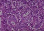 Thumbnail_Novus Biologicals Human Multi-tissue Tissue MicroArray (Cancer) Human Ovary
