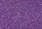 Thumbnail_Novus Biologicals Human Multi-tissue Tissue MicroArray (Cancer) Human Ovary