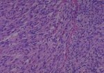 Thumbnail_Novus Biologicals Human Multi-tissue Tissue MicroArray (Cancer) Human Ovary