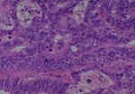 Thumbnail_Novus Biologicals Human Multi-tissue Tissue MicroArray (Cancer) Human Ovary