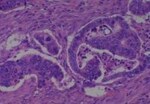 Thumbnail_Novus Biologicals Human Multi-tissue Tissue MicroArray (Cancer) Human Ovary