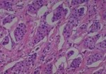 Thumbnail_Novus Biologicals Human Multi-tissue Tissue MicroArray (Cancer) Human Ovary
