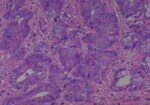 Thumbnail_Novus Biologicals Human Multi-tissue Tissue MicroArray (Cancer) Human Ovary