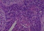 Thumbnail_Novus Biologicals Human Multi-tissue Tissue MicroArray (Cancer) Human Ovary